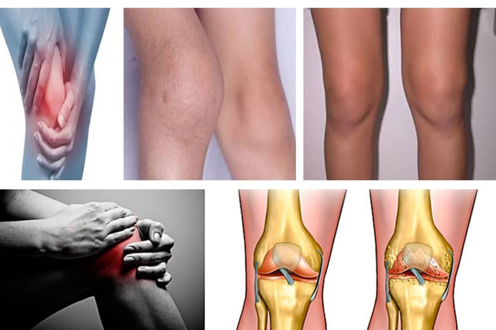 Knee arthrosis symptoms
